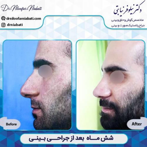 جراحی-بینی-1-46
