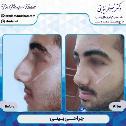 جراحی-بینی-1-48