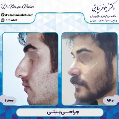 جراحی-بینی-1-49