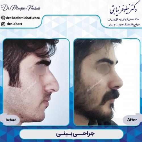 جراحی-بینی-2-49