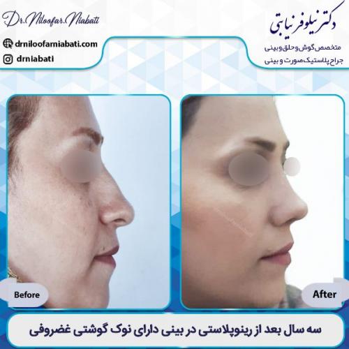 جراحی-بینی-2-50