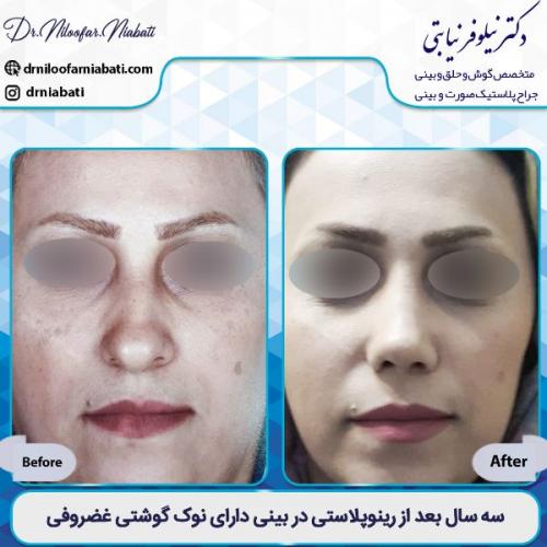 جراحی-بینی-3-50