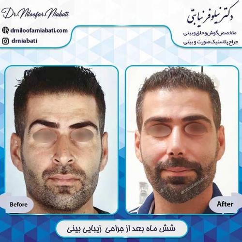جراحی-بینی-1-51