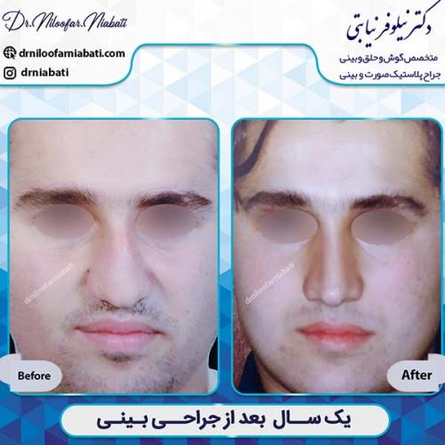 جراحی-بینی-1-52