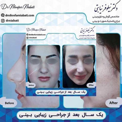 جراحی-بینی-63