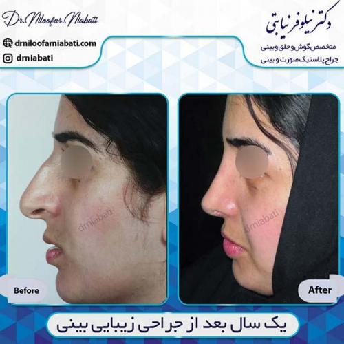 جراحی-بینی-69