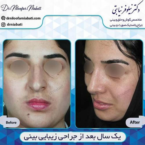 جراحی-بینی-70