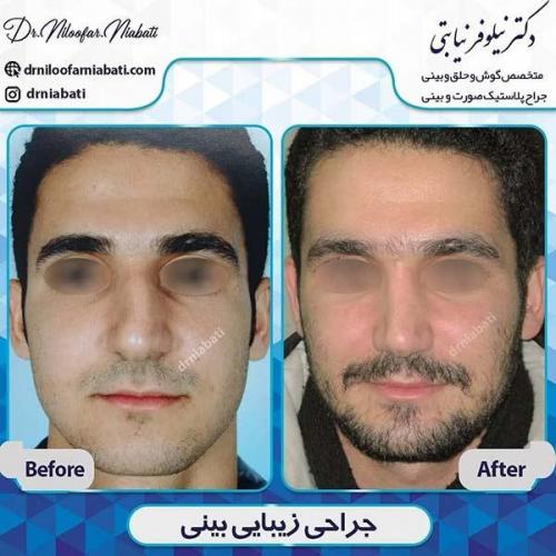 جراحی-بینی-71