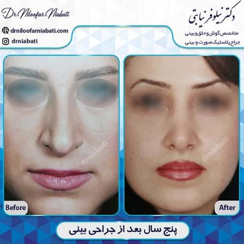 جراحی-بینی-91