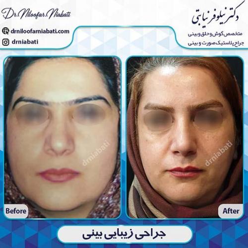 جراحی-بینی-92