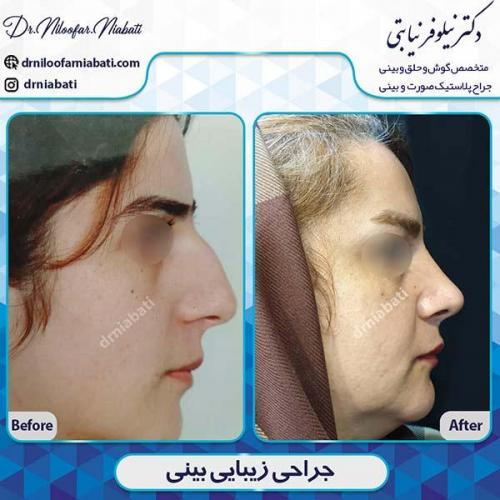 جراحی-بینی-93