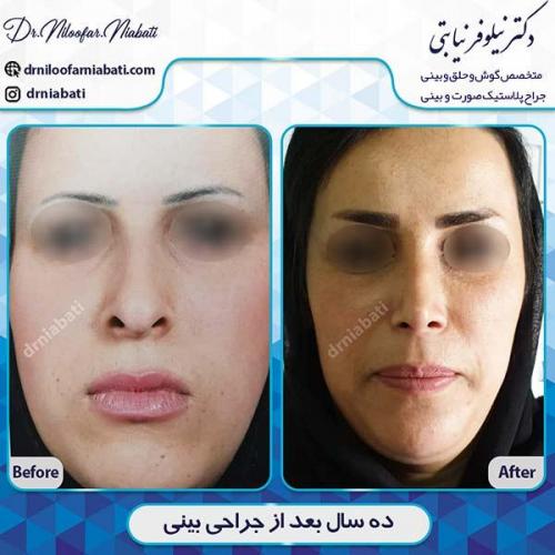 جراحی-بینی-95