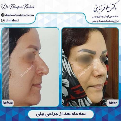 جراحی-بینی-99