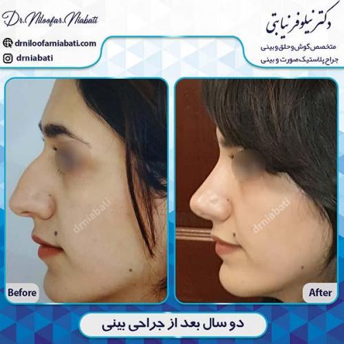 جراحی-بینی-100
