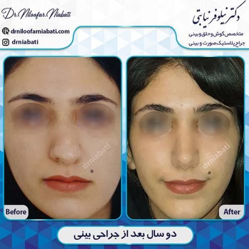 جراحی-بینی-101