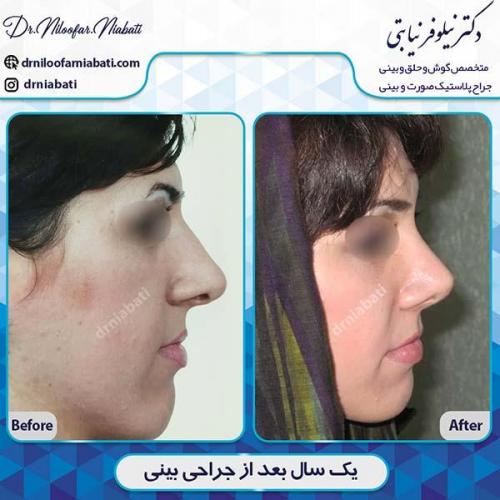 جراحی-بینی-105