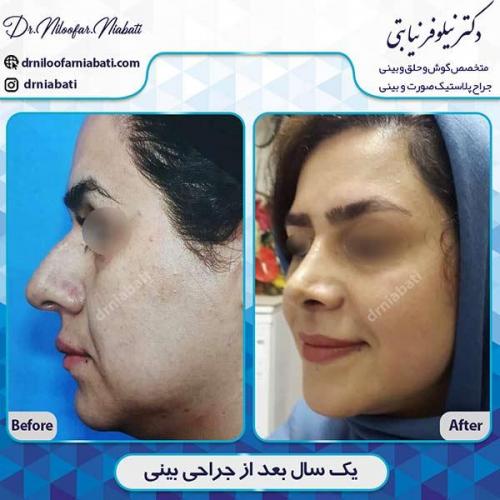 جراحی-بینی-108