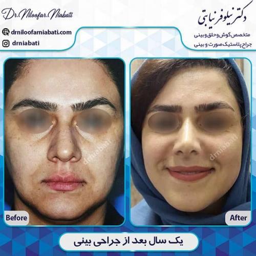 جراحی-بینی-110