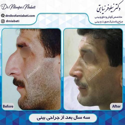جراحی-بینی-114