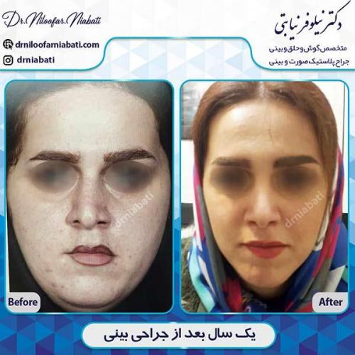 جراحی-بینی-116