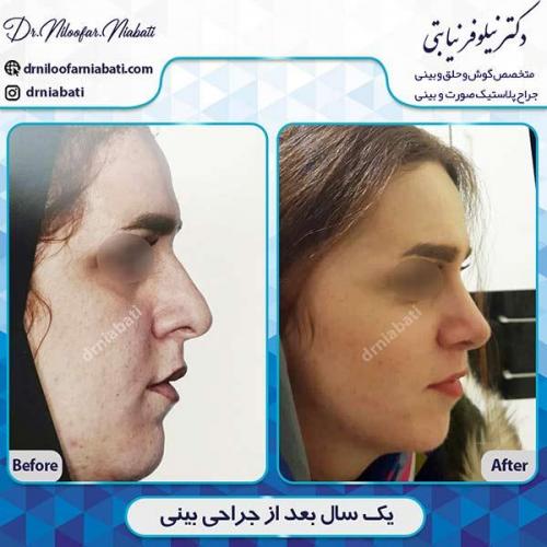 جراحی-بینی-118