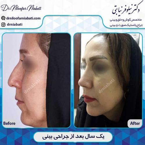 جراحی-بینی-120