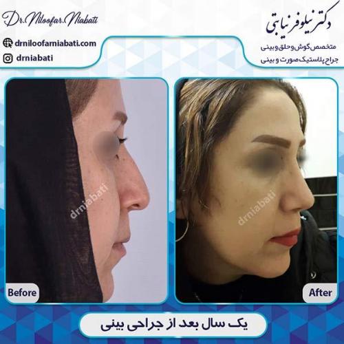 جراحی-بینی-121