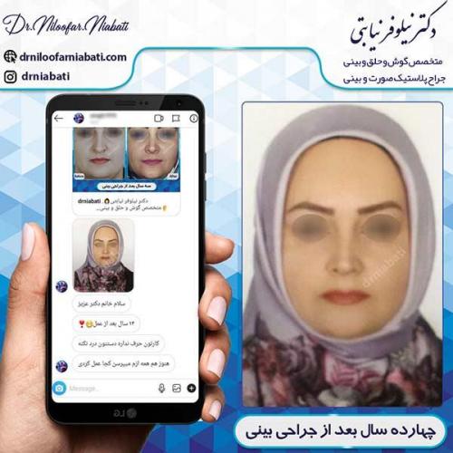 جراحی-بینی-131