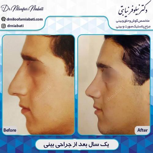جراحی-بینی-134