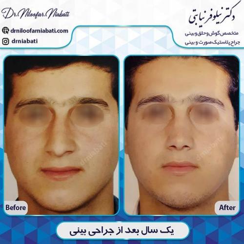 جراحی-بینی-135