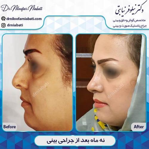 جراحی-بینی-147