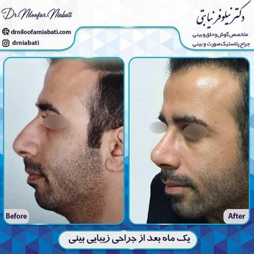 جراحی-بینی-166