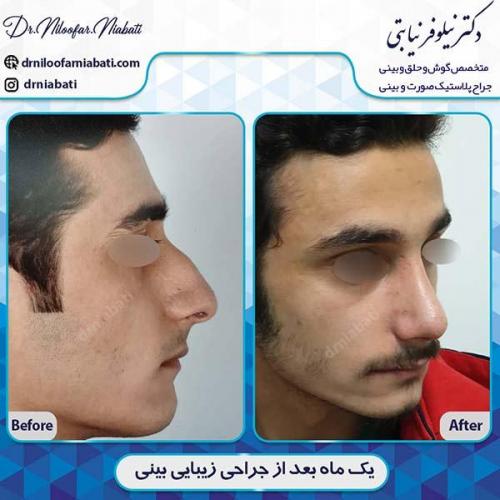 جراحی-بینی-167