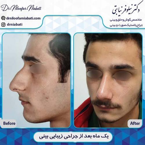 جراحی-بینی-168