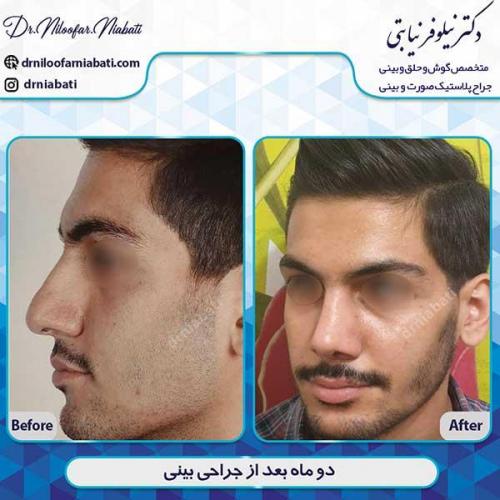 جراحی-بینی-171
