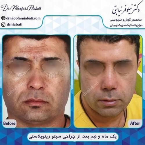 جراحی بینی 196 (4)