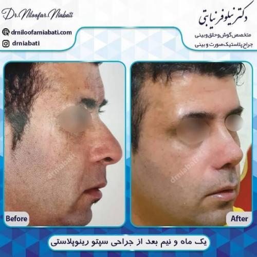 جراحی بینی 196 (5)