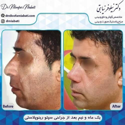 جراحی بینی 196 (6)