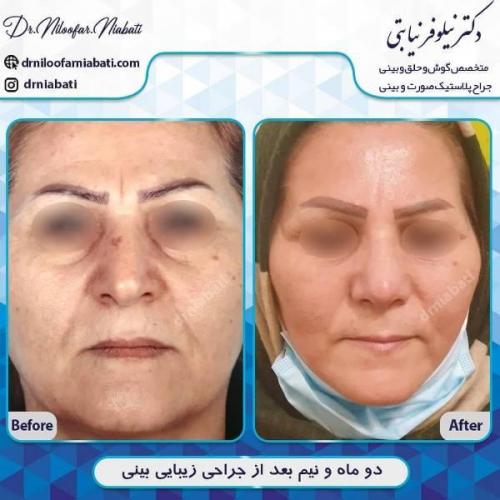 جراحی بینی 196 (8)