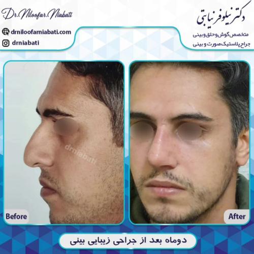 جراحی-بینی-211
