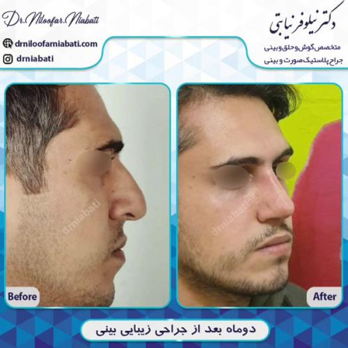 جراحی-بینی-212