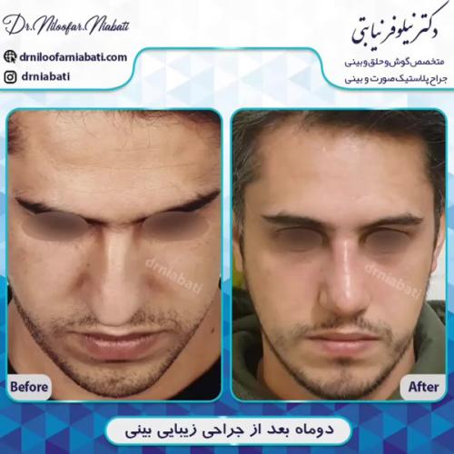 جراحی-بینی-213