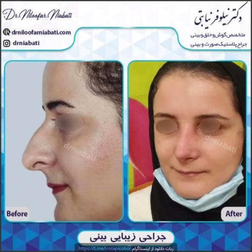 جراحی-بینی-214