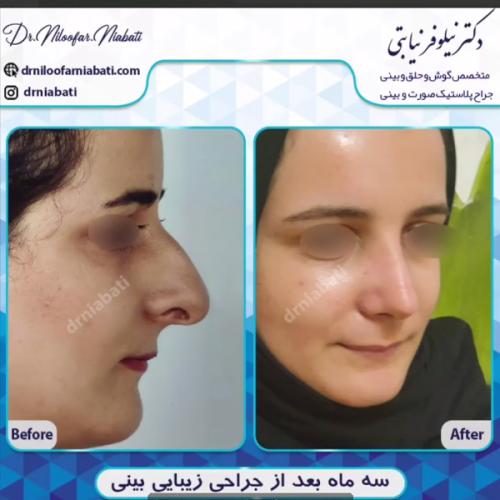 جراحی-بینی-215
