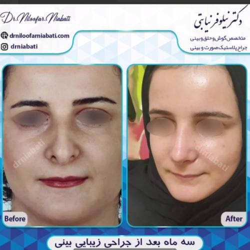 جراحی-بینی-216