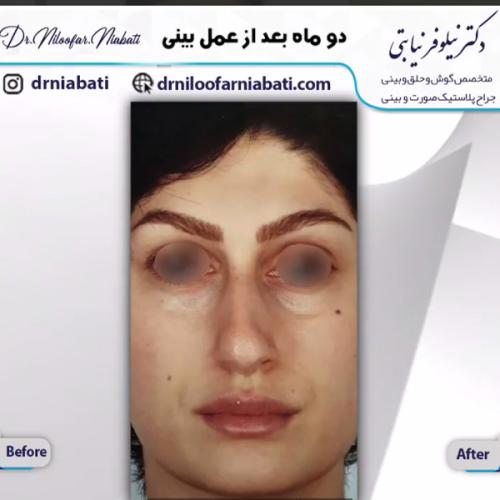 جراحی-بینی-220