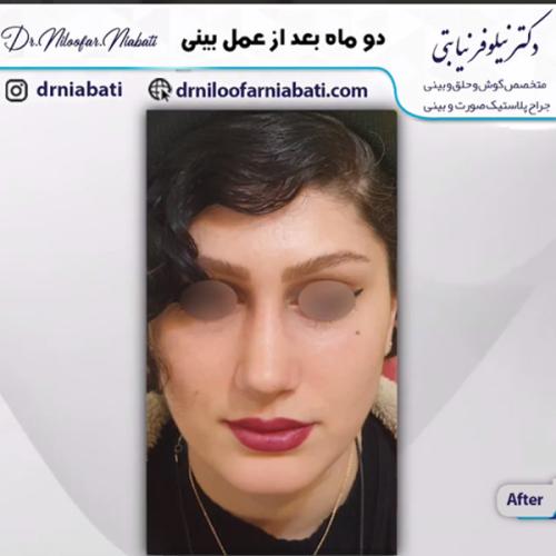 جراحی-بینی-221