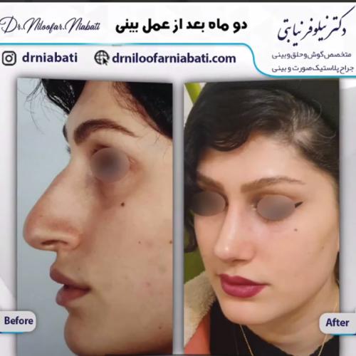 جراحی-بینی-222
