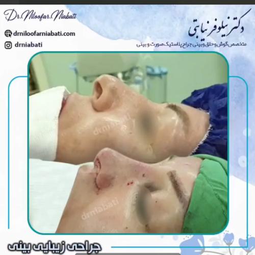 جراحی-بینی-223