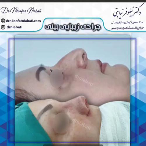 جراحی-بینی-224